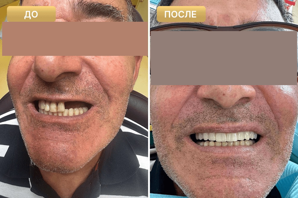 Пациент Full Clinic до и после лечения