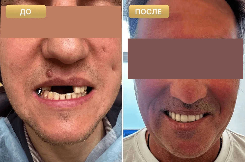 Пациент Full Clinic до и после лечения