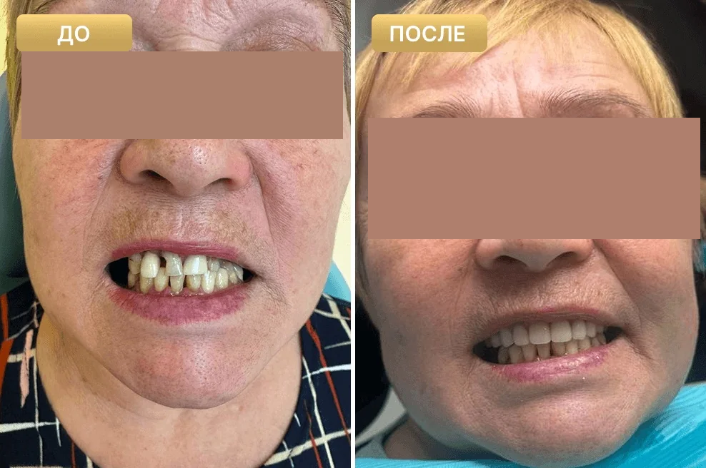 Пациент Full Clinic до и после лечения