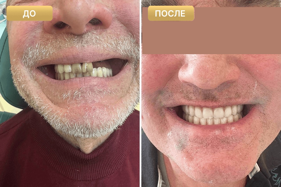 Пациент Full Clinic до и после лечения