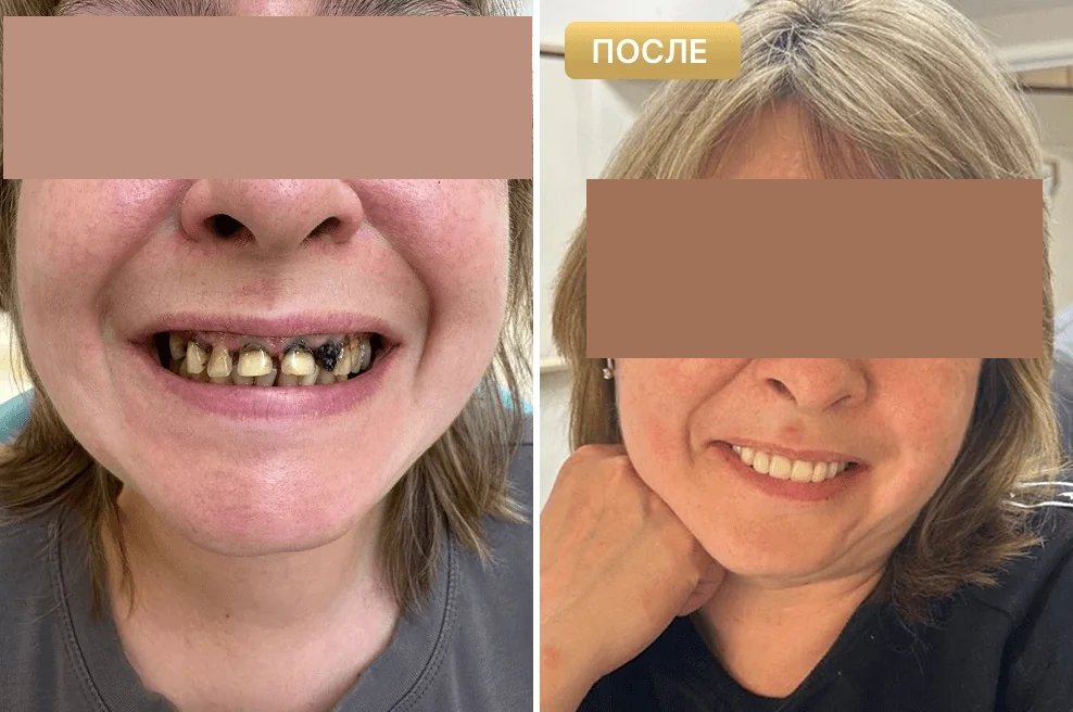 Пациент Full Clinic до и после лечения