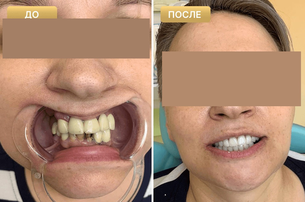 Пациент Full Clinic до и после лечения
